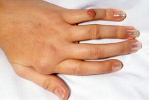 bolest v deformovaných prstech