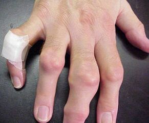 prsty s deformacemi kloubů způsobují bolest