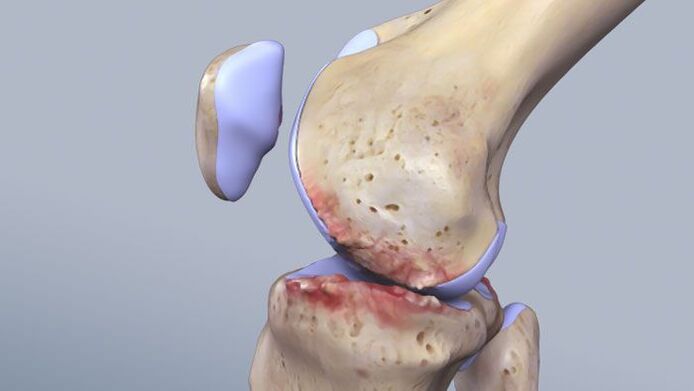 Struktura kolenního kloubu postižená patologií