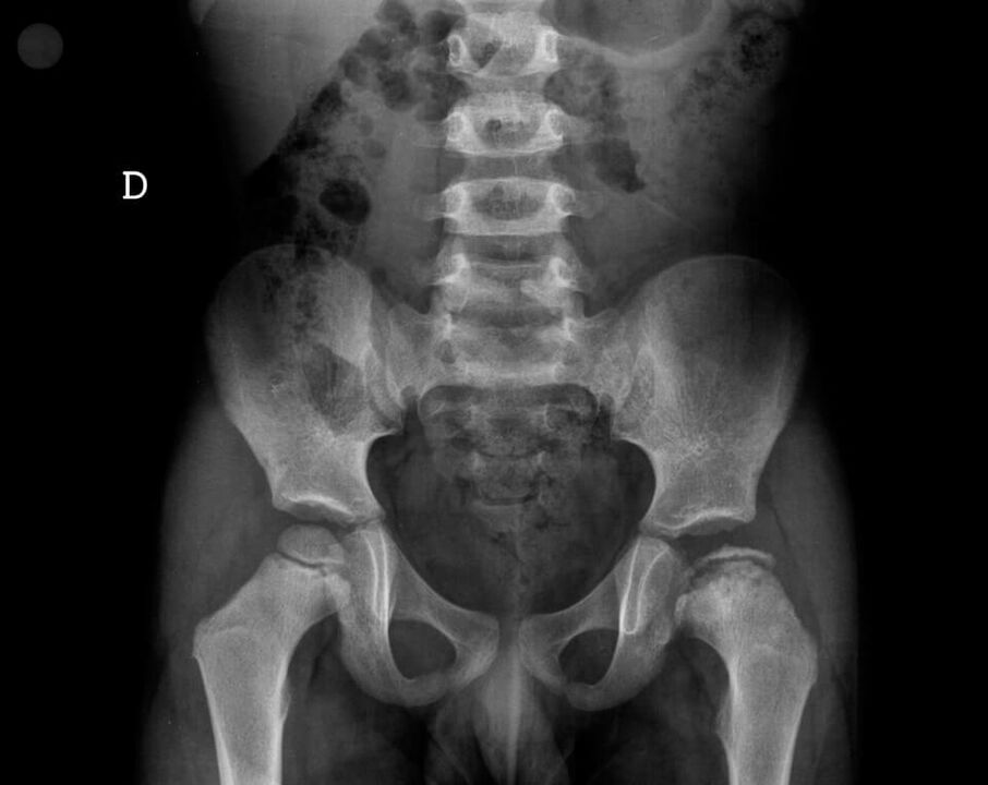 Legg-Calvé-Perthesova choroba – nekróza chrupavkové tkáně hlavice femuru