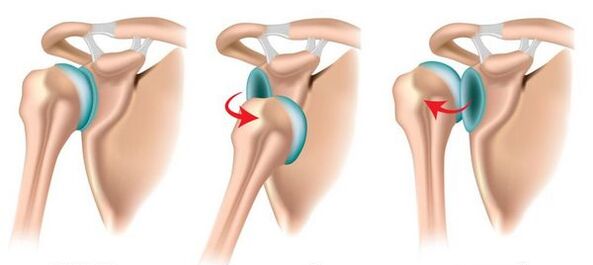Přední a zadní dislokace ramenního kloubu, provokující rozvoj artrózy