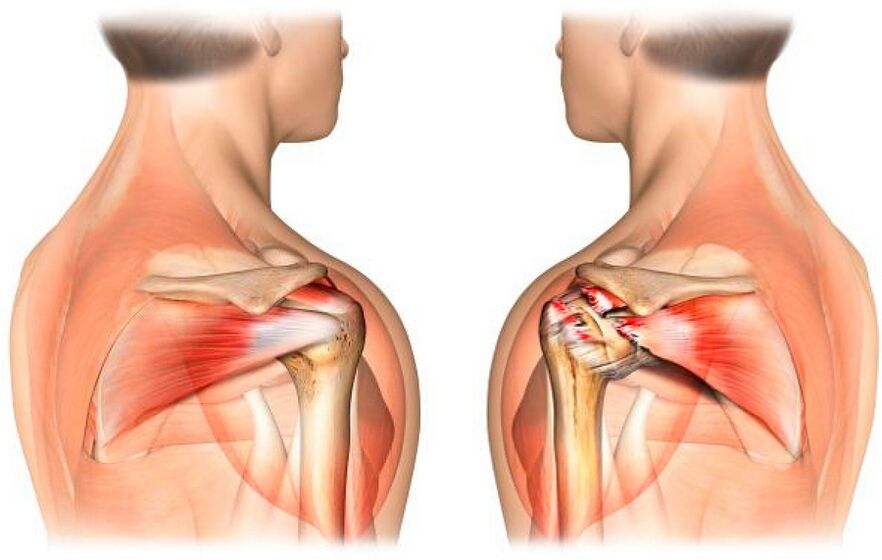 Zdravé a artrózou postižené rameno