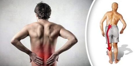 Syndrom bolesti s bederní osteochondózou vyzařuje nohy