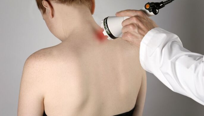 laserová terapie cervikální osteochondrózy